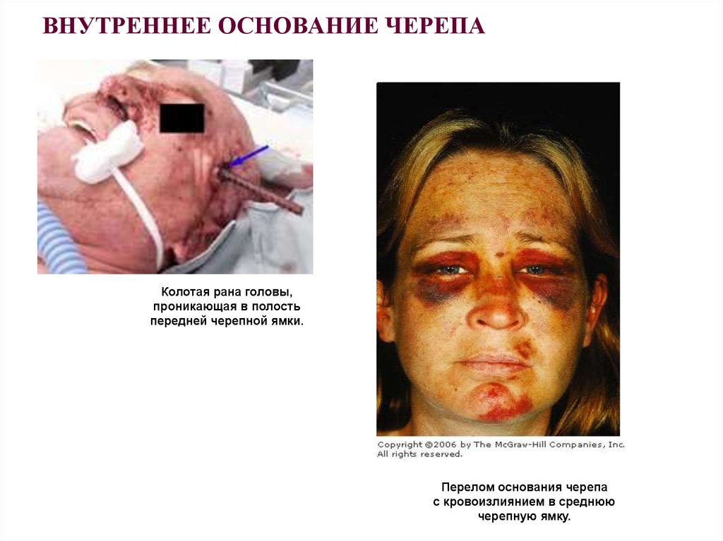 ВНУТРЕННЕЕ ОСНОВАНИЕ ЧЕРЕПА