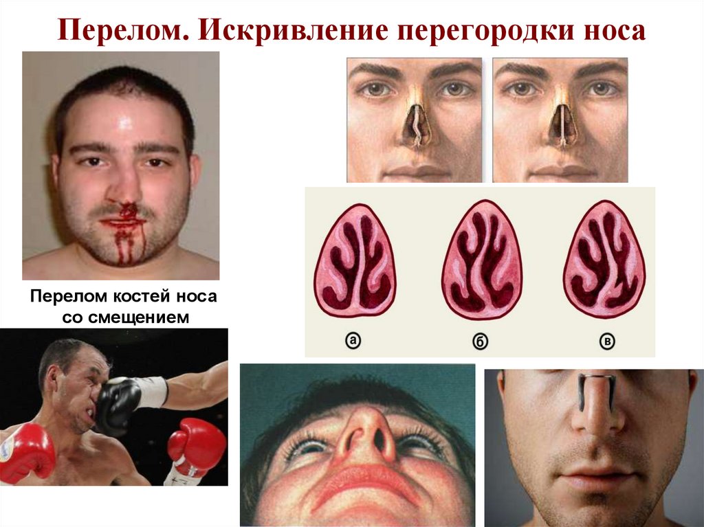Перелом. Искривление перегородки носа