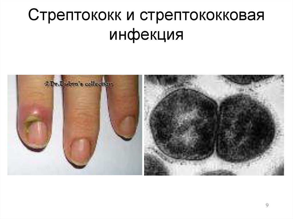 Стрептококк и стрептококковая инфекция