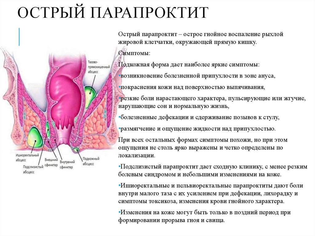 Острый парапроктит