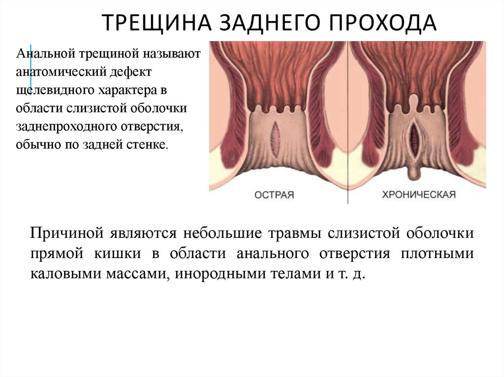 Трещина заднего прохода