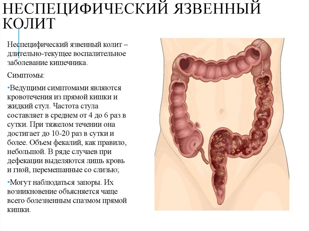 Неспецифический язвенный колит
