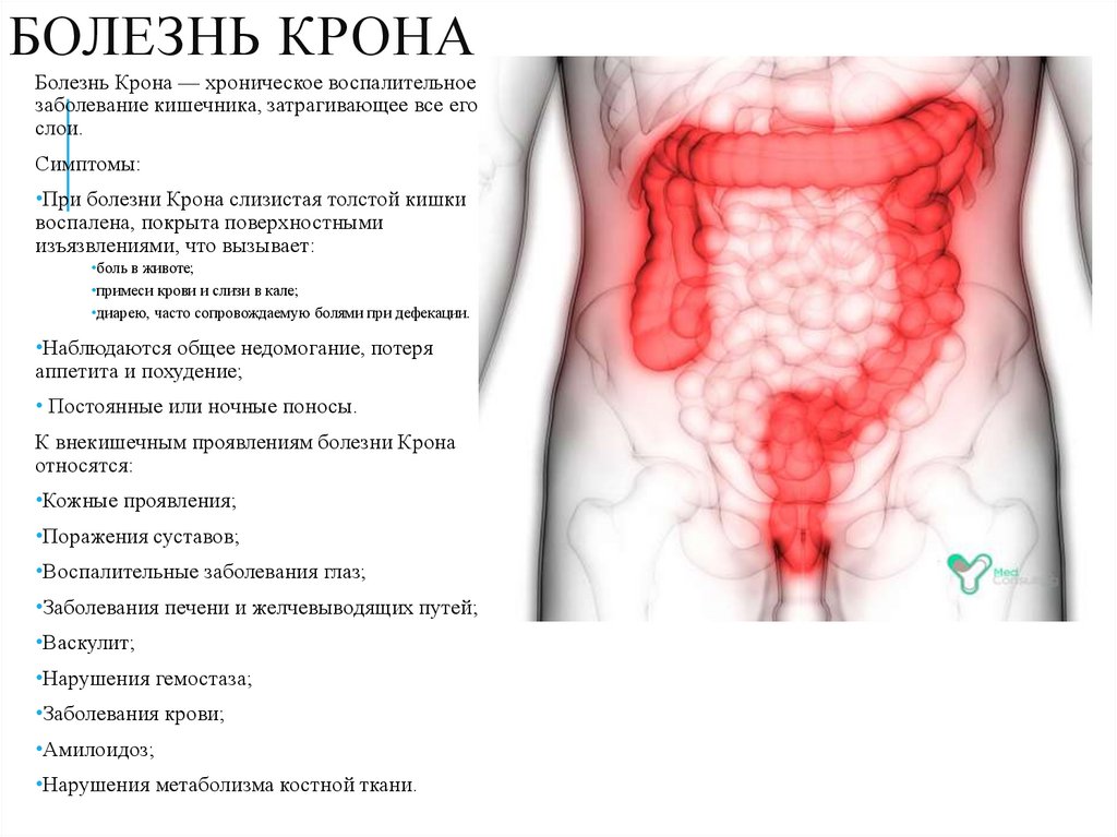 Болезнь Крона