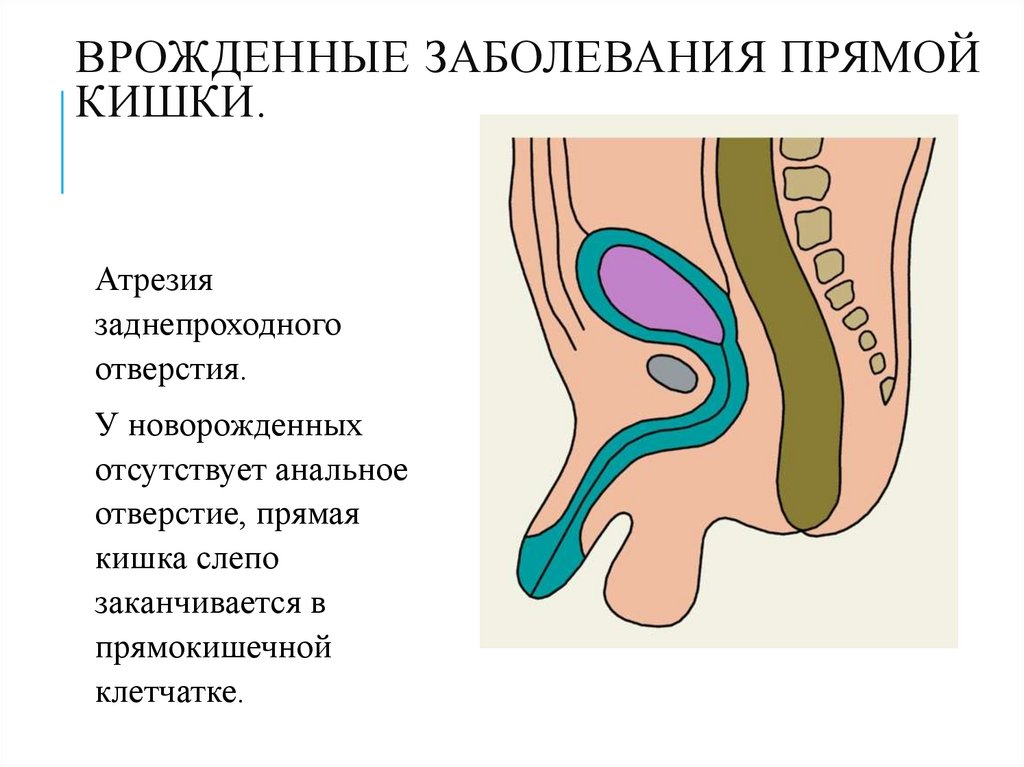 Врожденные заболевания прямой кишки.