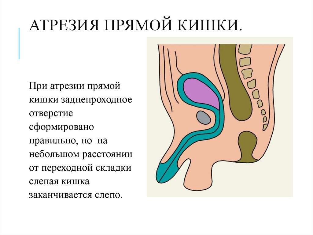 Атрезия прямой кишки.