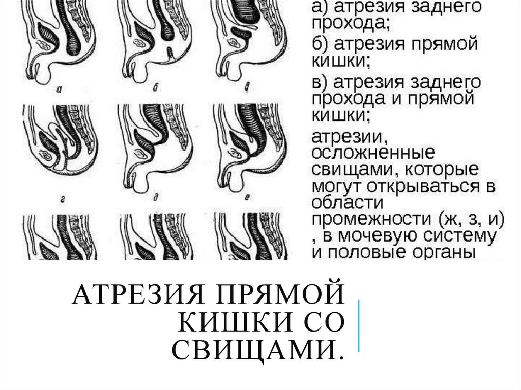 Атрезия прямой кишки со свищами.