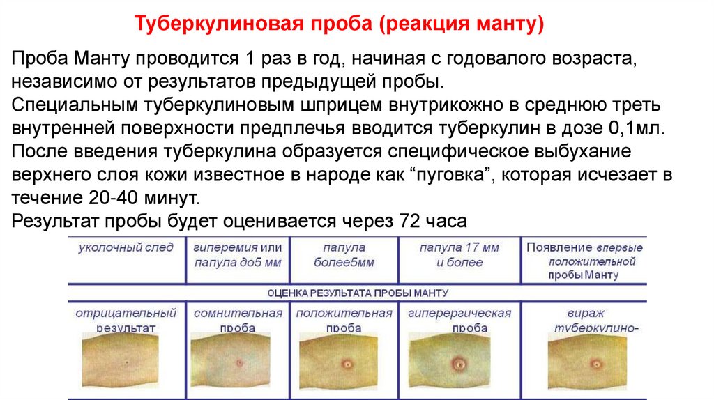 Туберкулиновая проба (реакция манту)