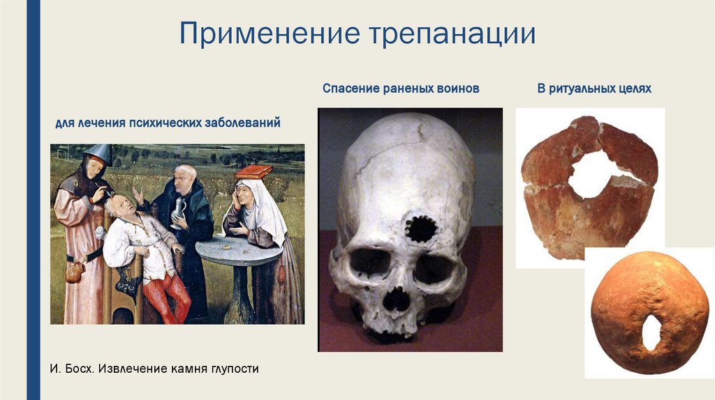 Применение трепанации