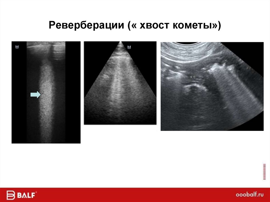 Реверберации (« хвост кометы»)