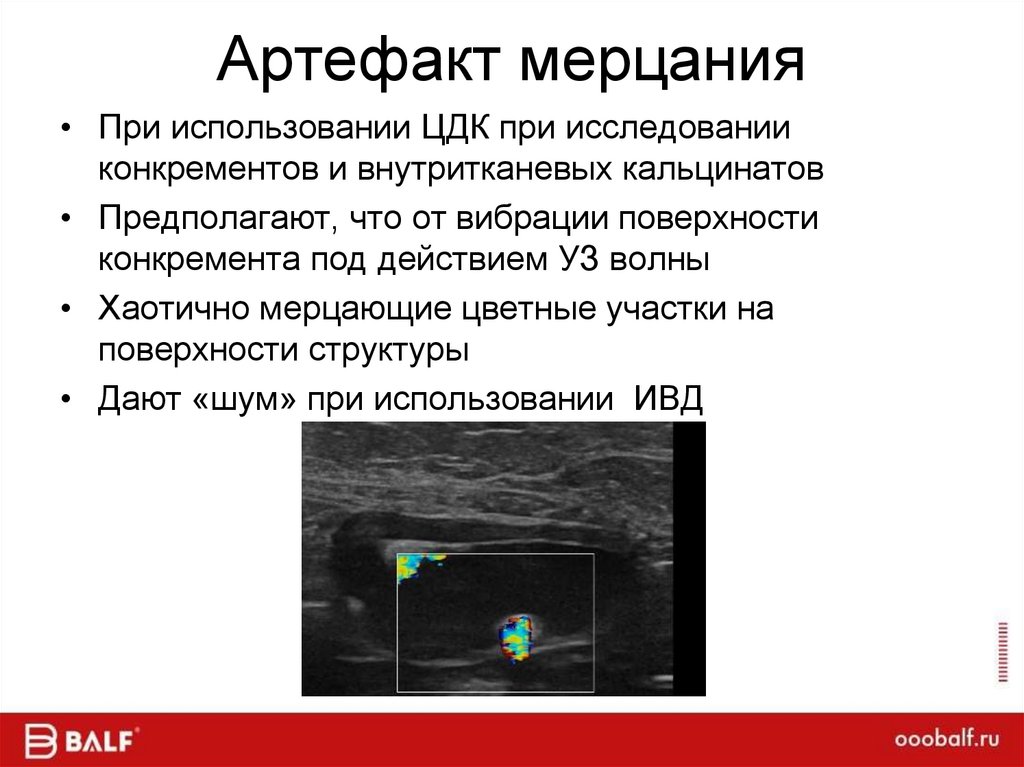 Артефакт мерцания