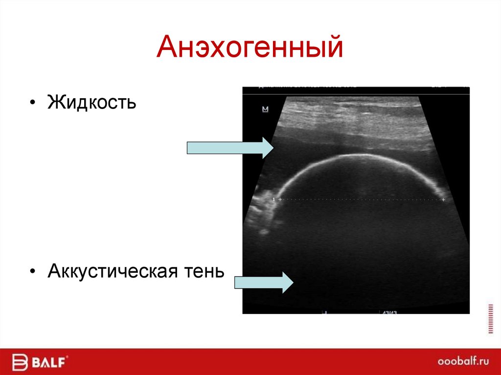 Анэхогенный