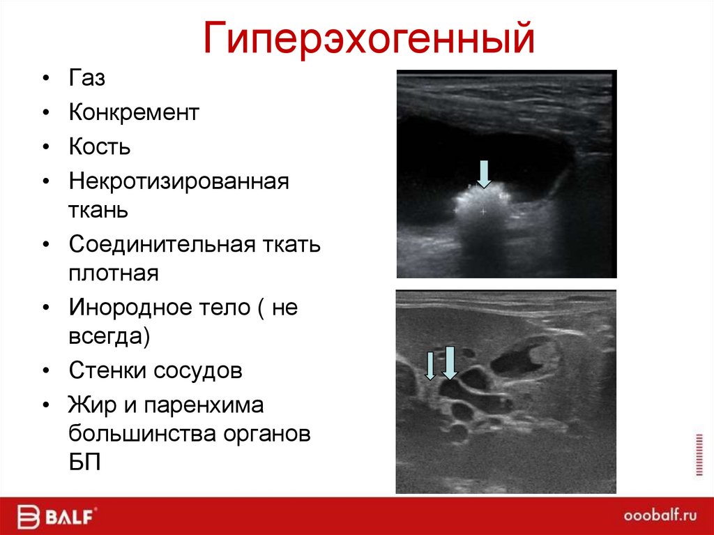 Гиперэхогенный
