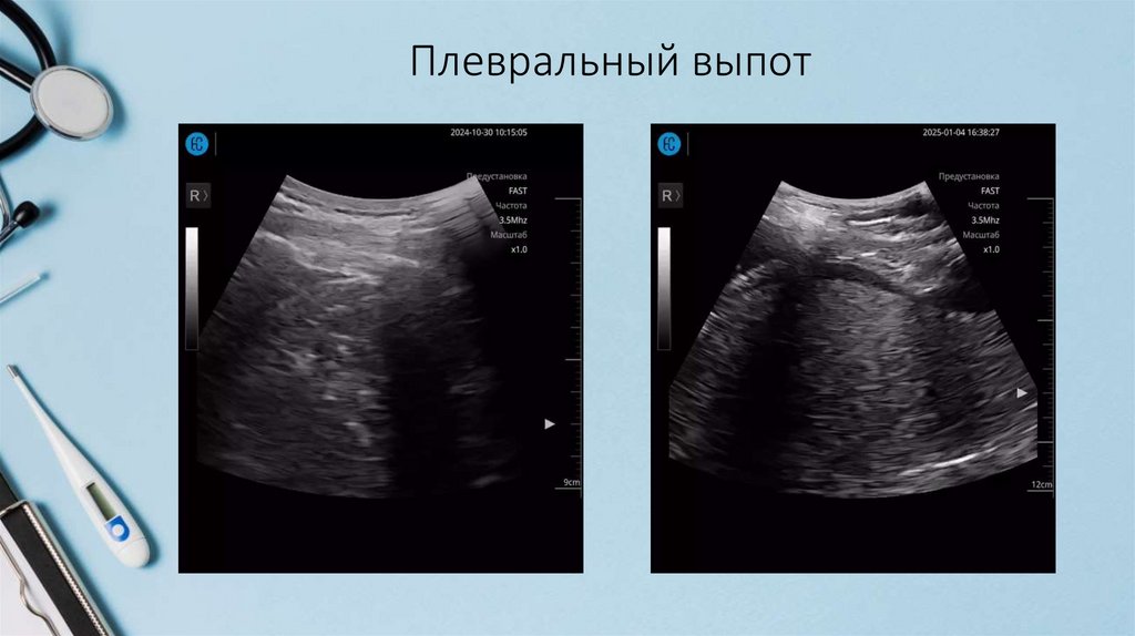 Плевральный выпот