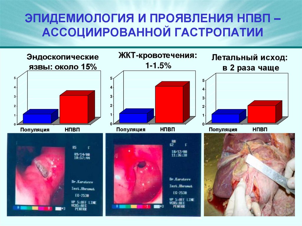 ЭПИДЕМИОЛОГИЯ И ПРОЯВЛЕНИЯ НПВП – АССОЦИИРОВАННОЙ ГАСТРОПАТИИ