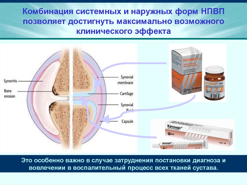 Комбинация системных и наружных форм НПВП позволяет достигнуть максимально возможного клинического эффекта