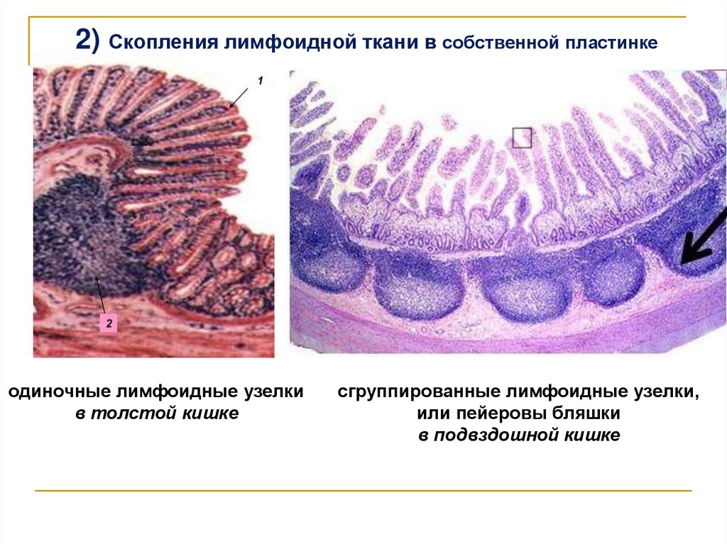 2) Скопления лимфоидной ткани в собственной пластинке