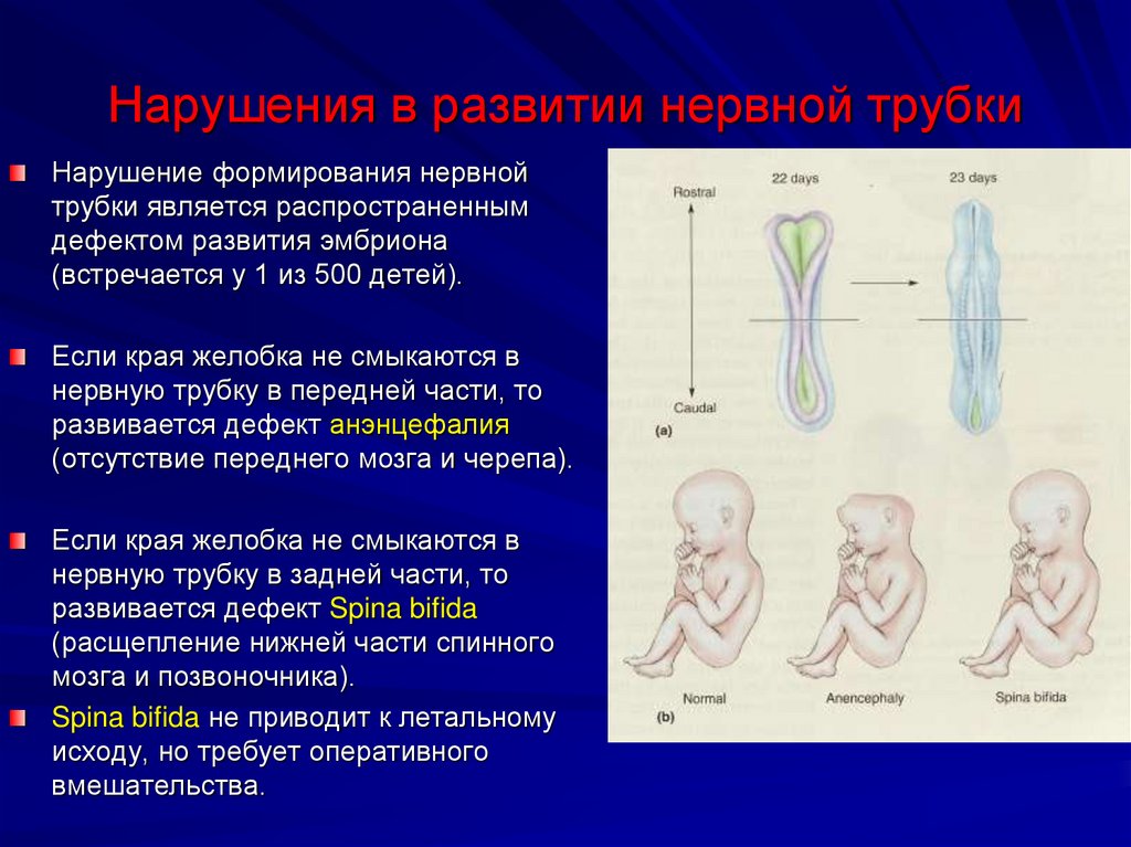 Нарушения в развитии нервной трубки
