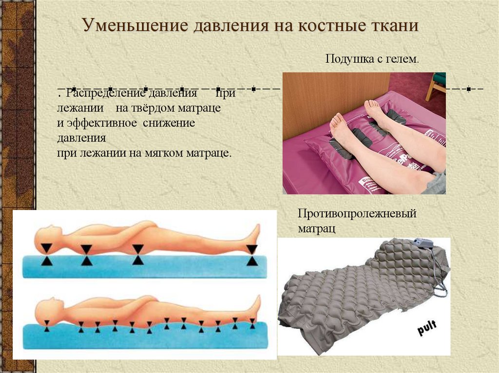 Уменьшение давления на костные ткани