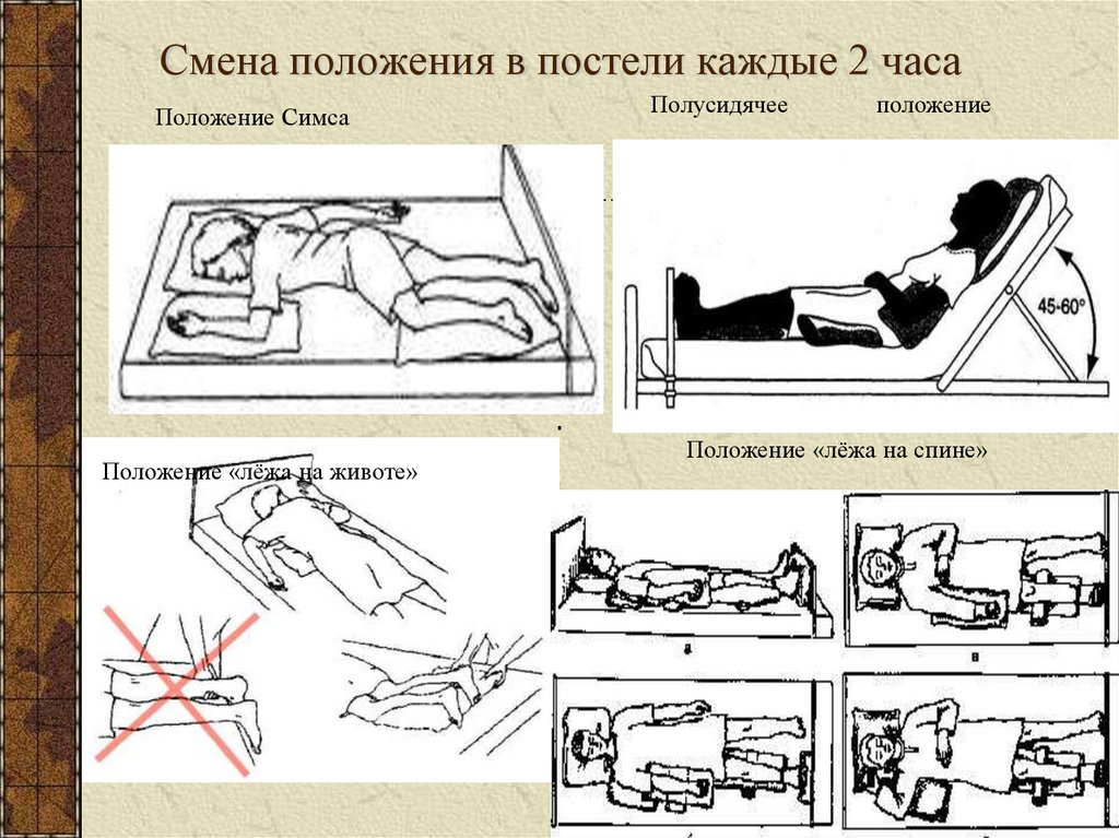 Смена положения в постели каждые 2 часа