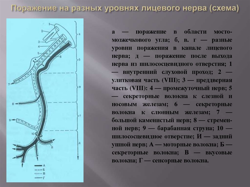 Поражение на разных уровнях лицевого нерва (схема)
