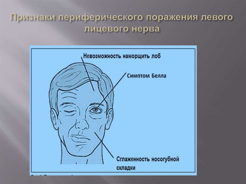 Признаки периферического поражения левого лицевого нерва