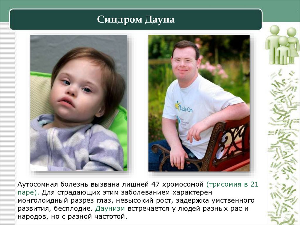 Синдром Дауна