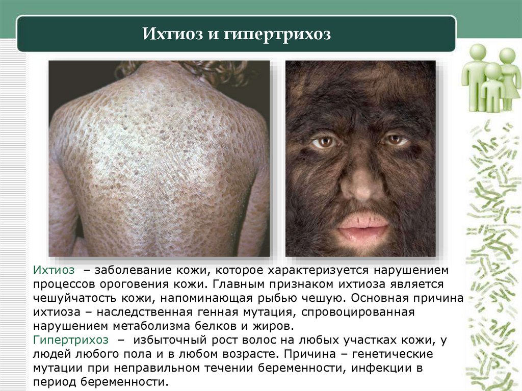 Ихтиоз и гипертрихоз