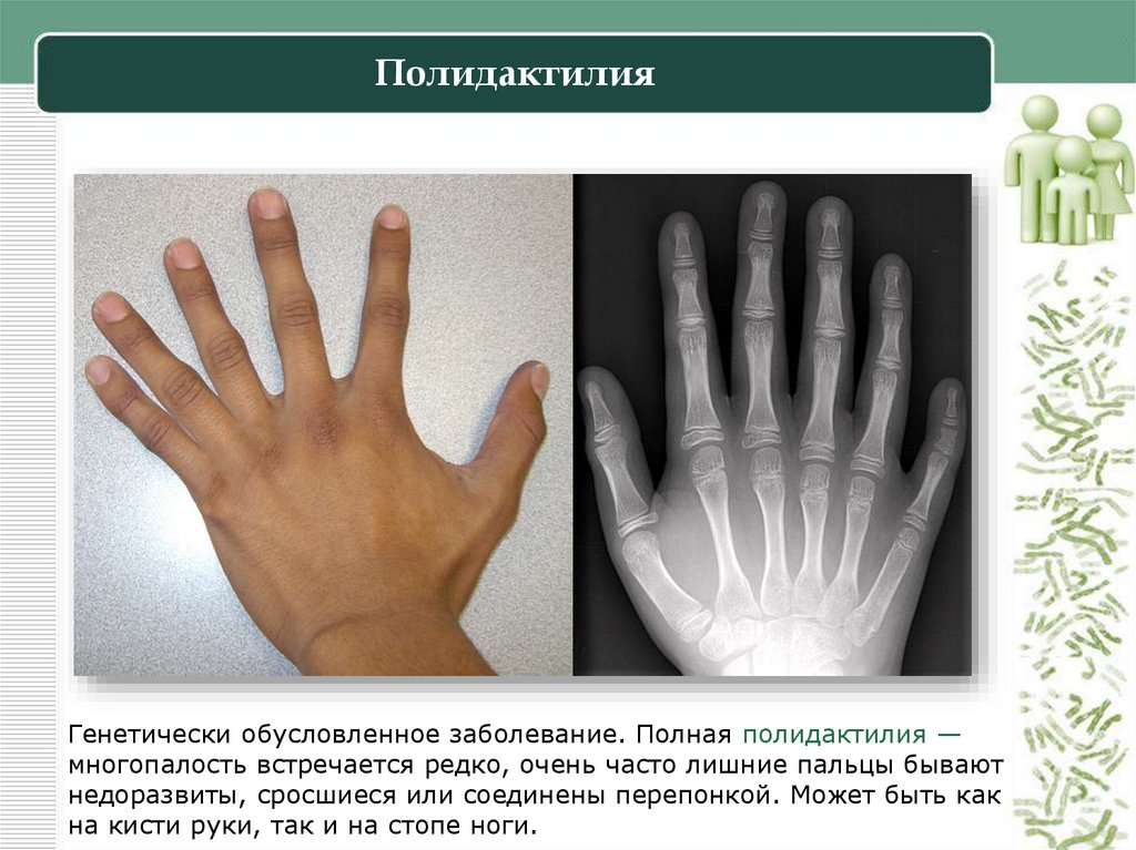 Полидактилия