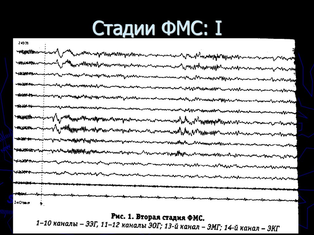 Стадии ФМС: I
