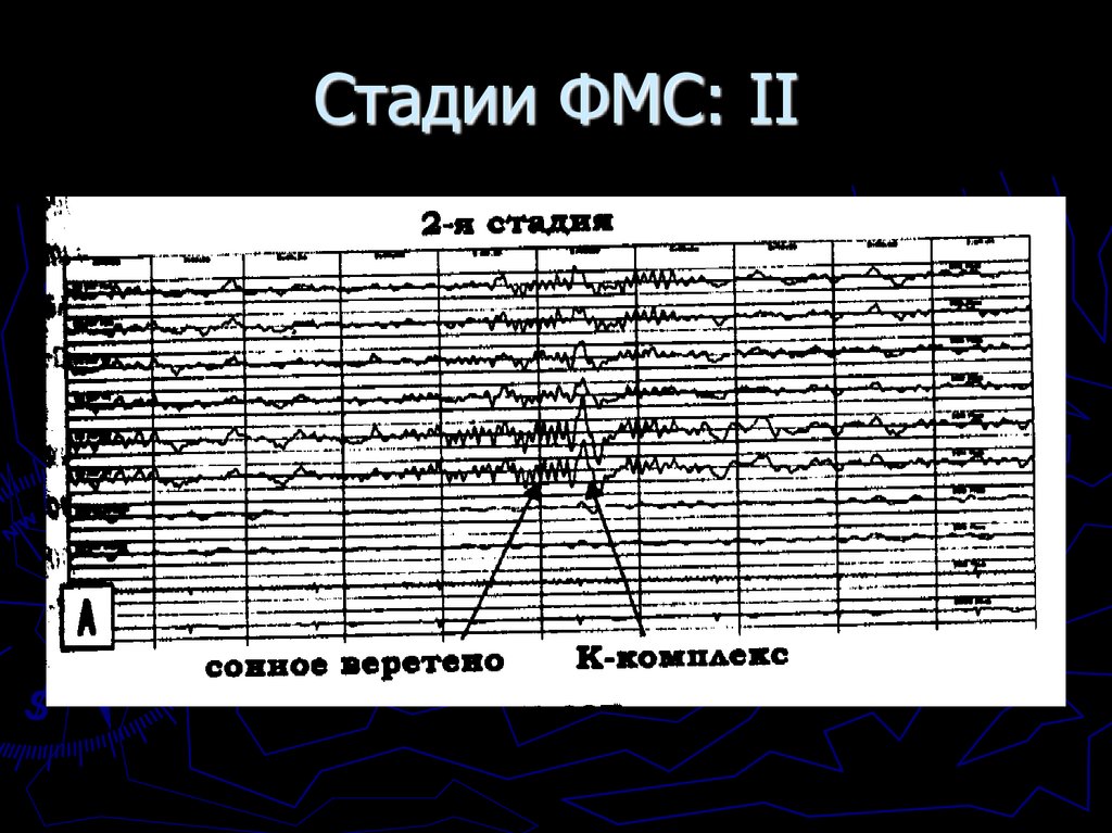 Стадии ФМС: II