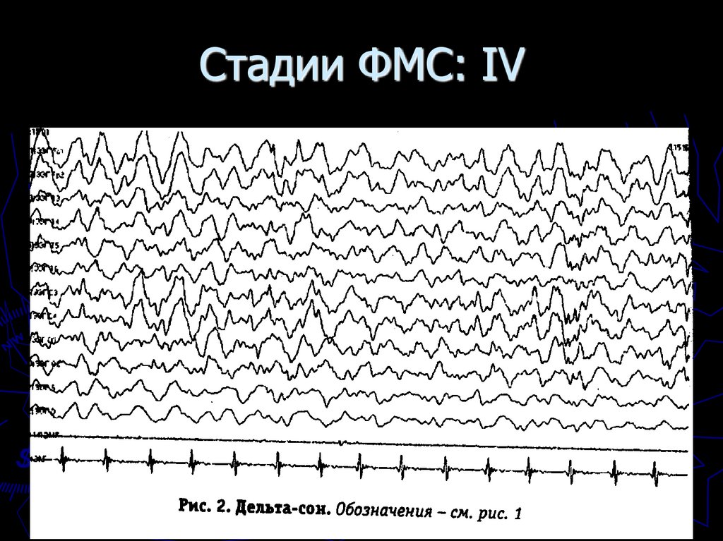 Стадии ФМС: IV