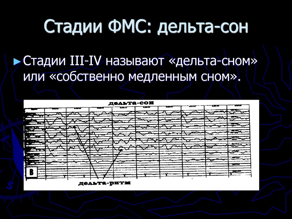Стадии ФМС: дельта-сон