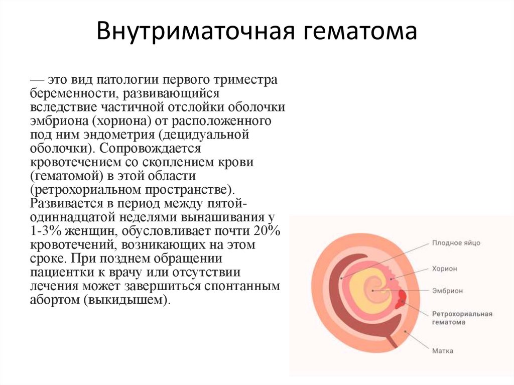 Внутриматочная гематома