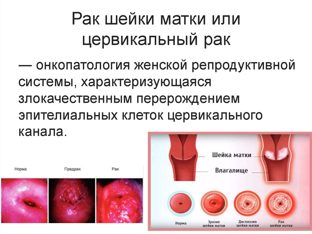 Рак шейки матки или цервикальный рак