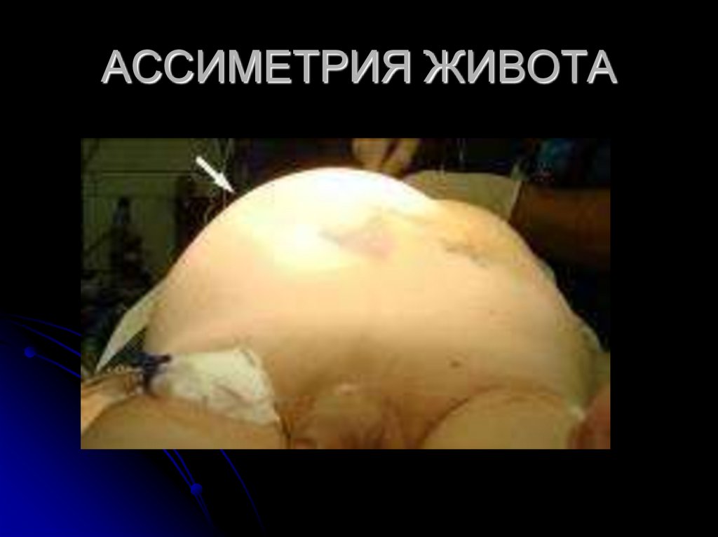 АССИМЕТРИЯ ЖИВОТА