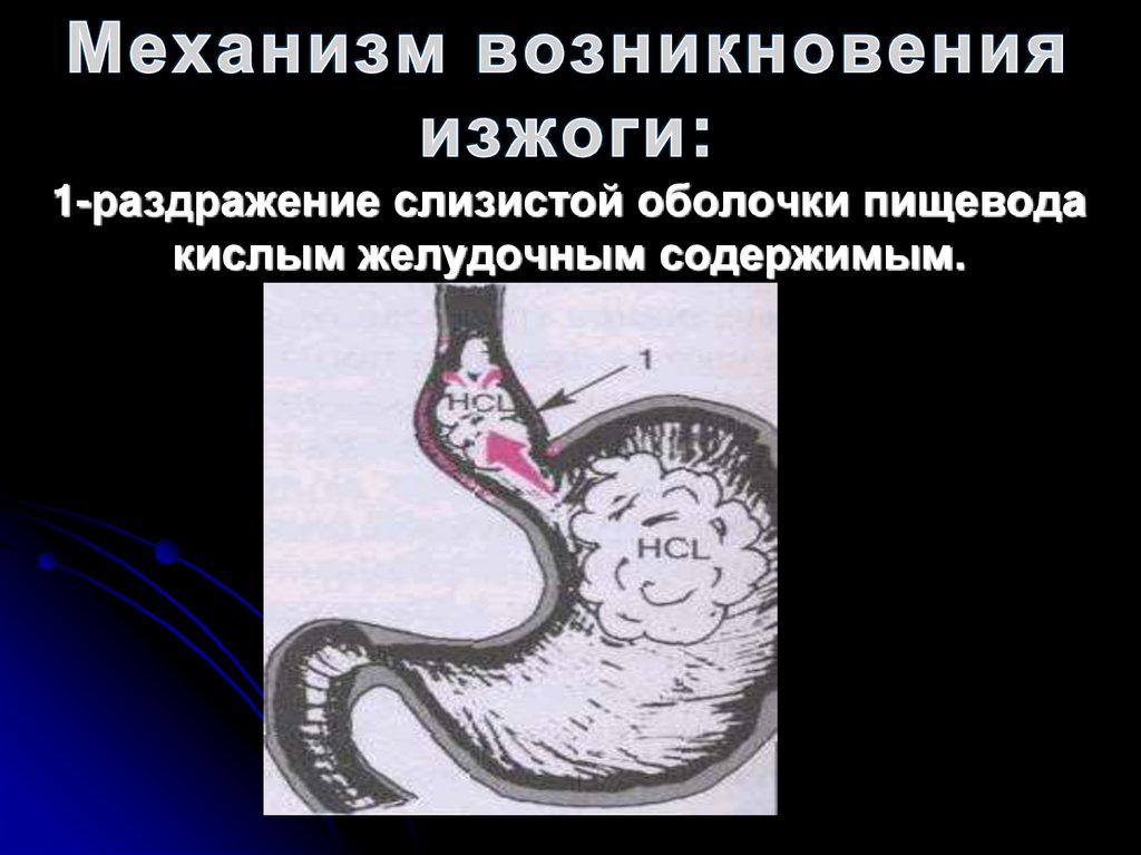 Механизм возникновения изжоги: 1-раздражение слизистой оболочки пищевода кислым желудочным содержимым.