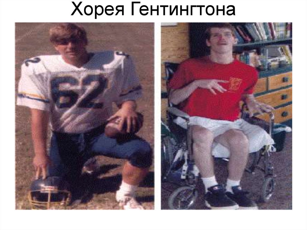 Хорея Гентингтона