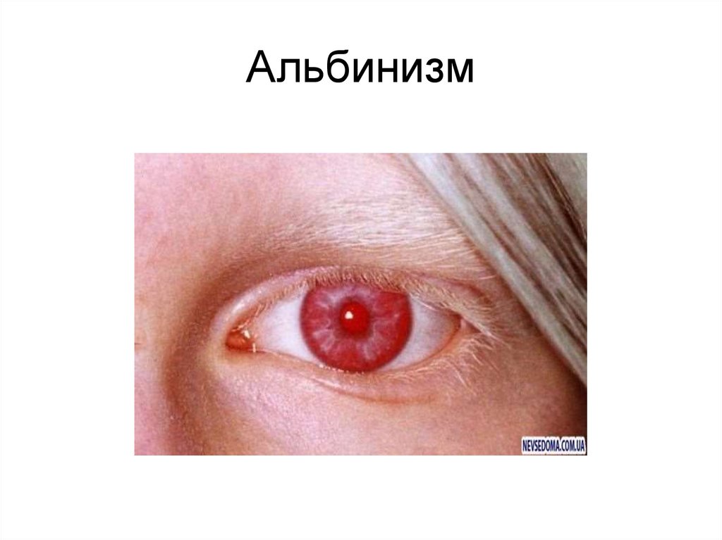 Альбинизм