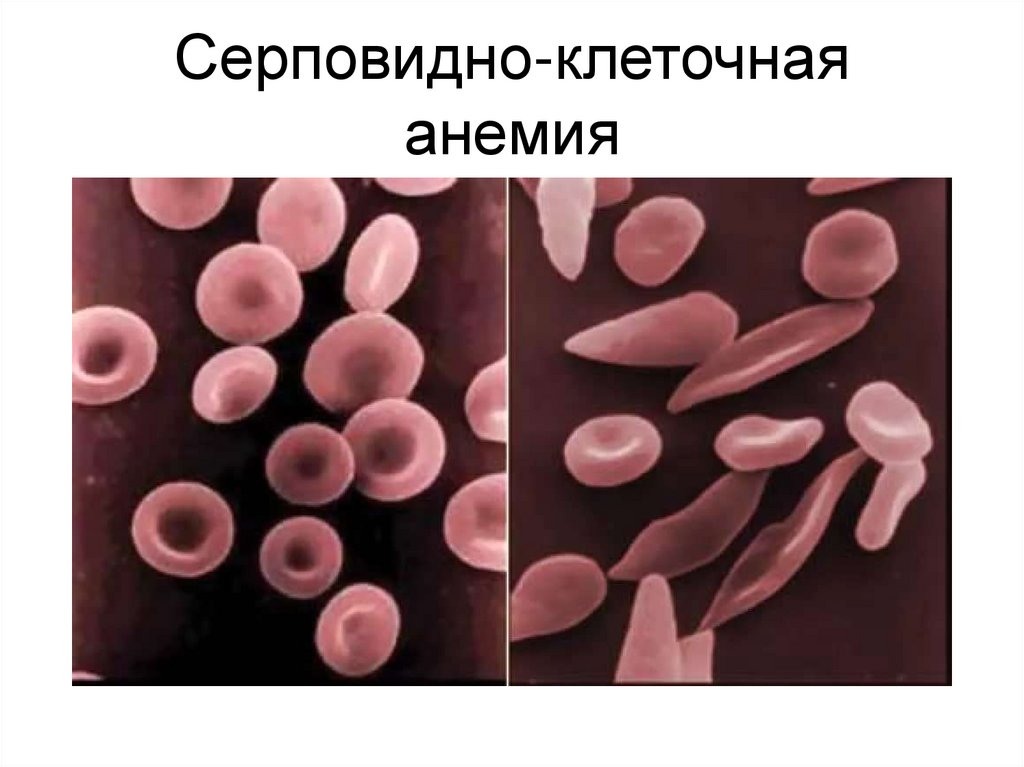 Серповидно-клеточная анемия