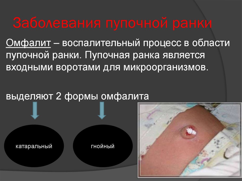 Заболевания пупочной ранки