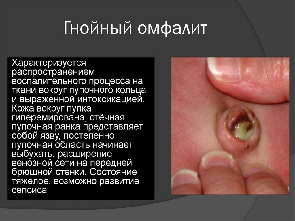 Гнойный омфалит