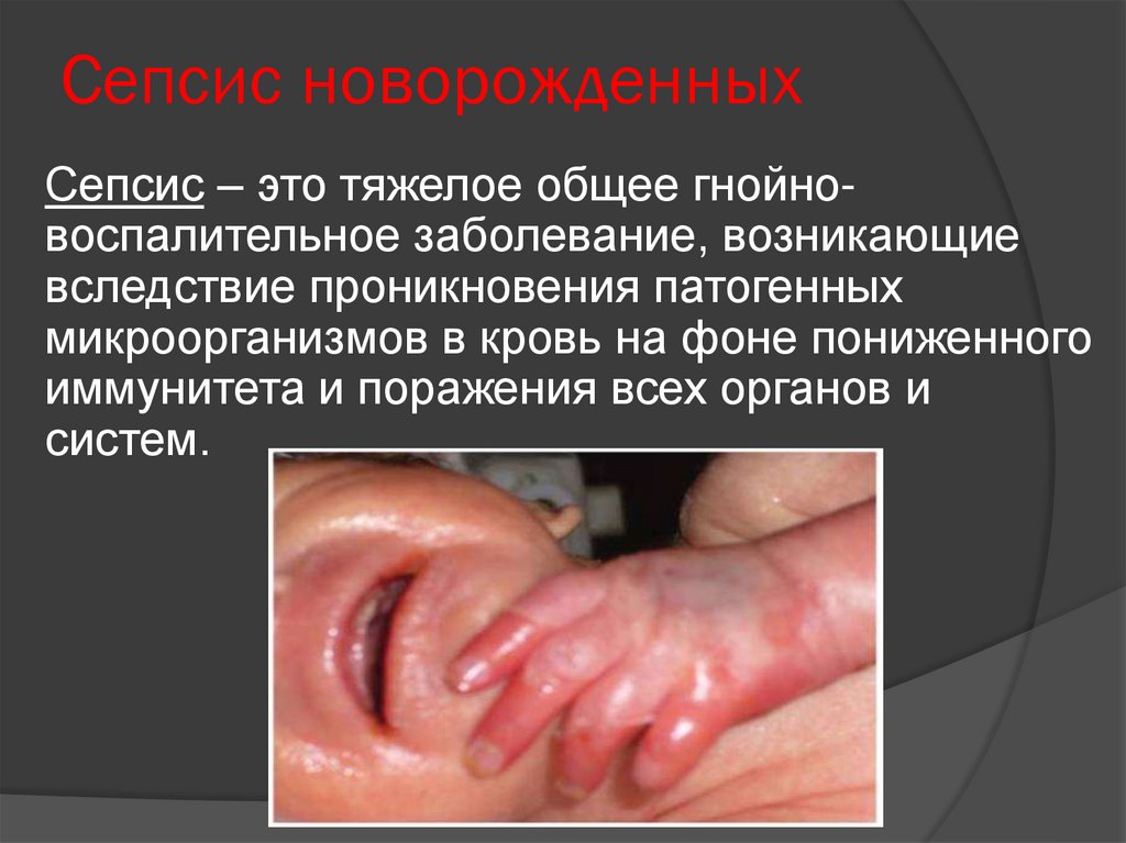 Сепсис новорожденных