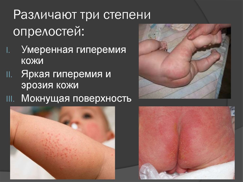 Различают три степени опрелостей: