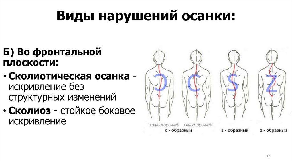 Виды нарушений осанки: