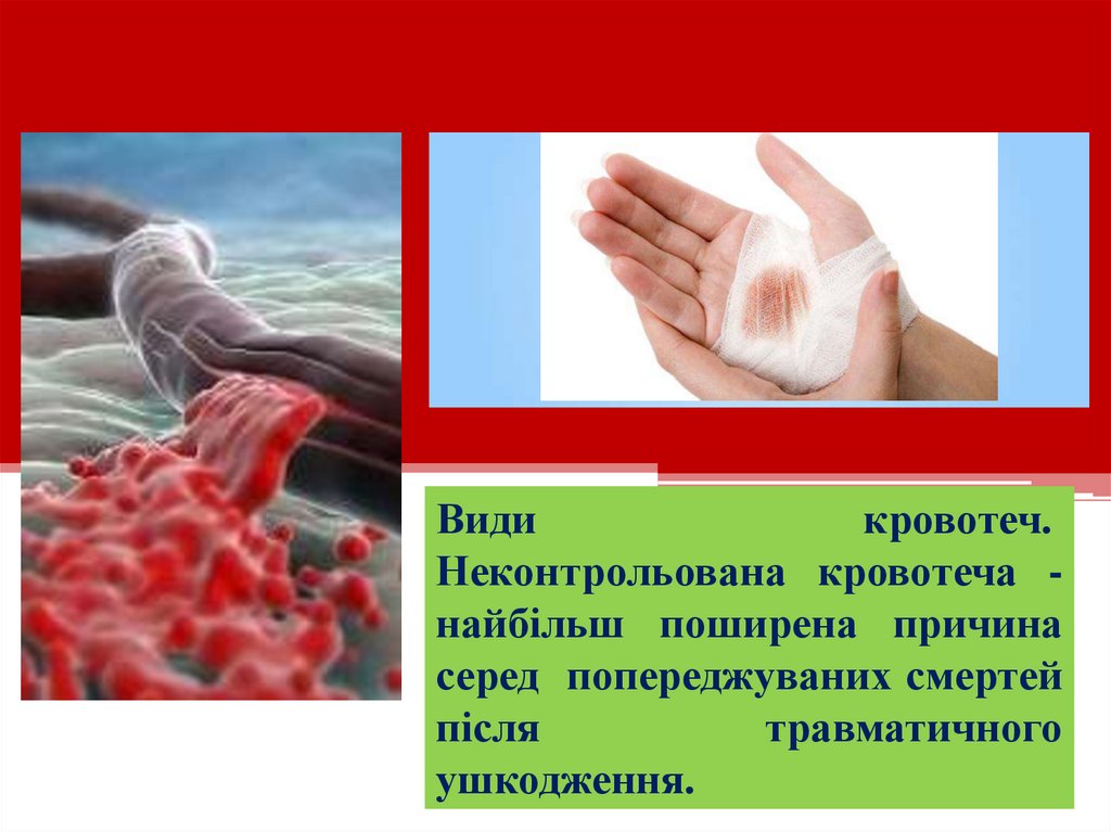 Види кровотеч.  Неконтрольована кровотеча - найбільш поширена причина серед попереджуваних смертей після травматичного