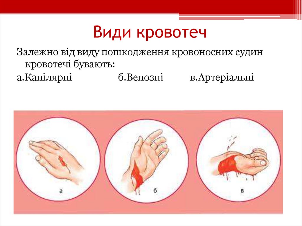 Види кровотеч