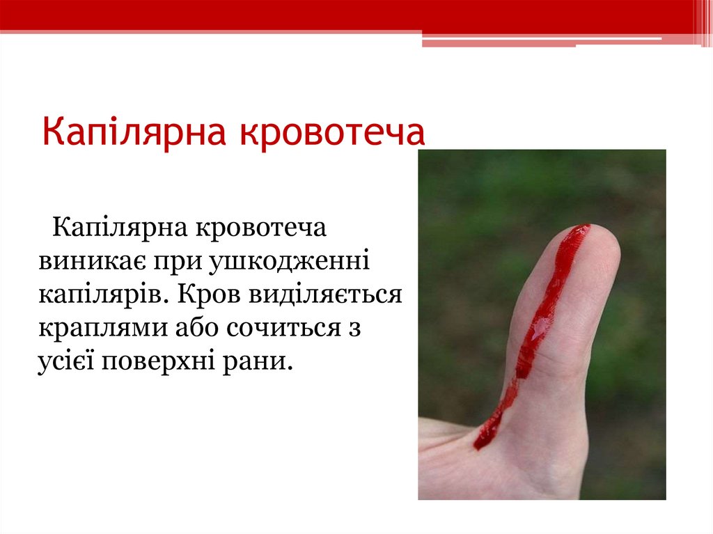 Капілярна кровотеча