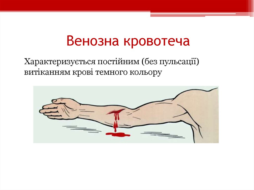 Венозна кровотеча