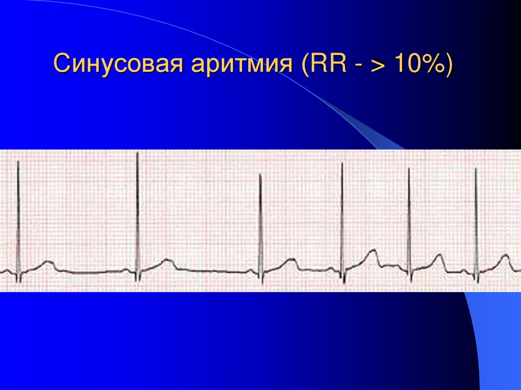 Синусовая аритмия (RR - > 10%)