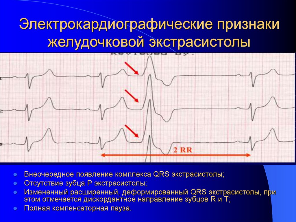 Электрокардиографические признаки желудочковой экстрасистолы